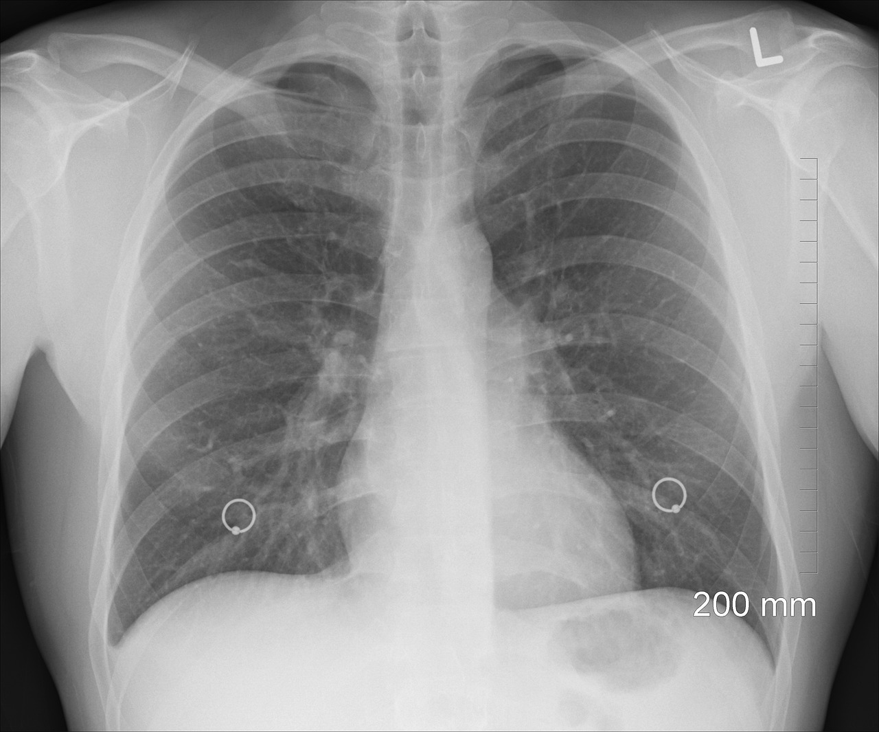 diagnosis, xray, chest-1476620.jpg